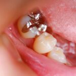 The Power of Silver Teeth Crowns for Safeguarding Baby Teeth